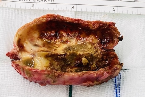 腹痛一年竟是「陶瓷膽囊」！30多歲女取出鈣化膽囊如石頭般堅硬