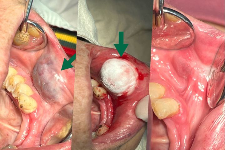 良性口腔血管病變常在舌、頰黏膜、口底等部位出現紅紫或藍紫色外觀（左圖箭頭所示），利用冷凍槍凍結壞死病灶（中圖箭頭所示），良性口腔血管病變利用冷凍槍治療後成果（右圖）。圖/長庚醫院提供
