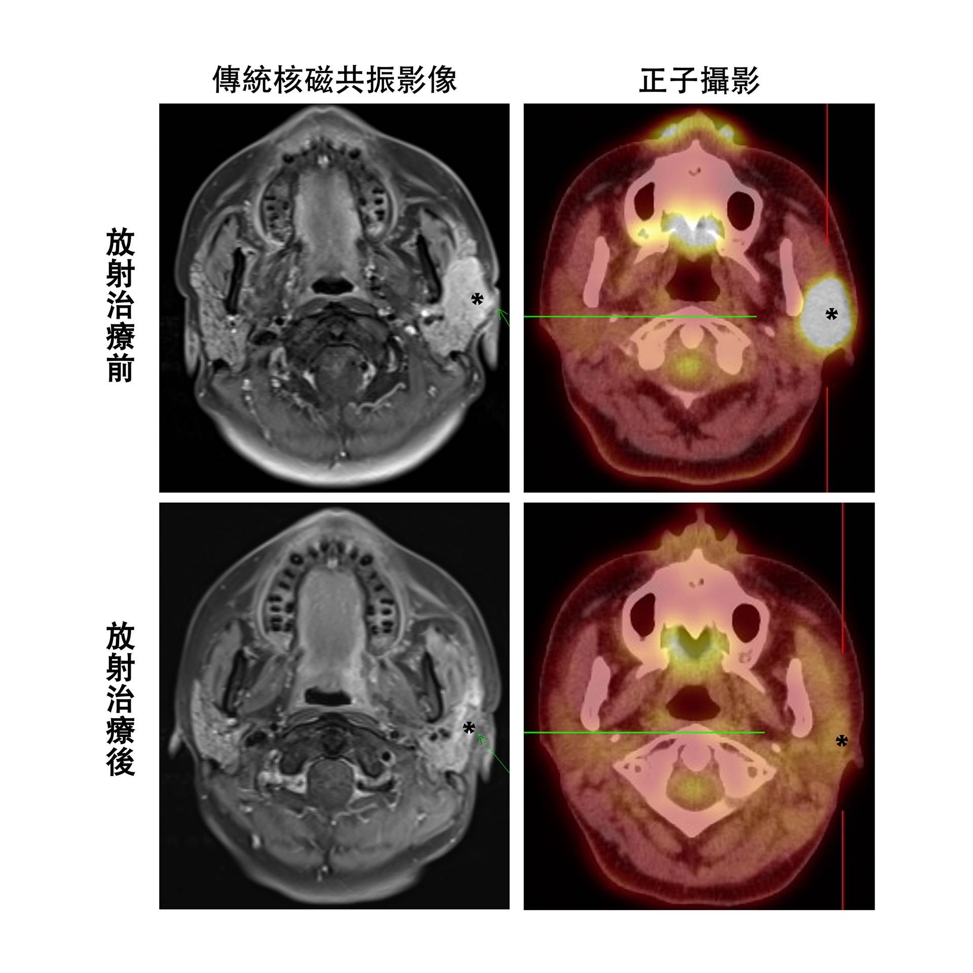 傳統核磁共振影像（左上與左下）難判別唾液腺癌放射治療後的發炎反應或殘存腫瘤（綠色箭頭與星號）；正子攝影（右上與右下）能更準確地評估治療反應（星號），從而減少不必要的醫療介入。圖/長庚醫院提供