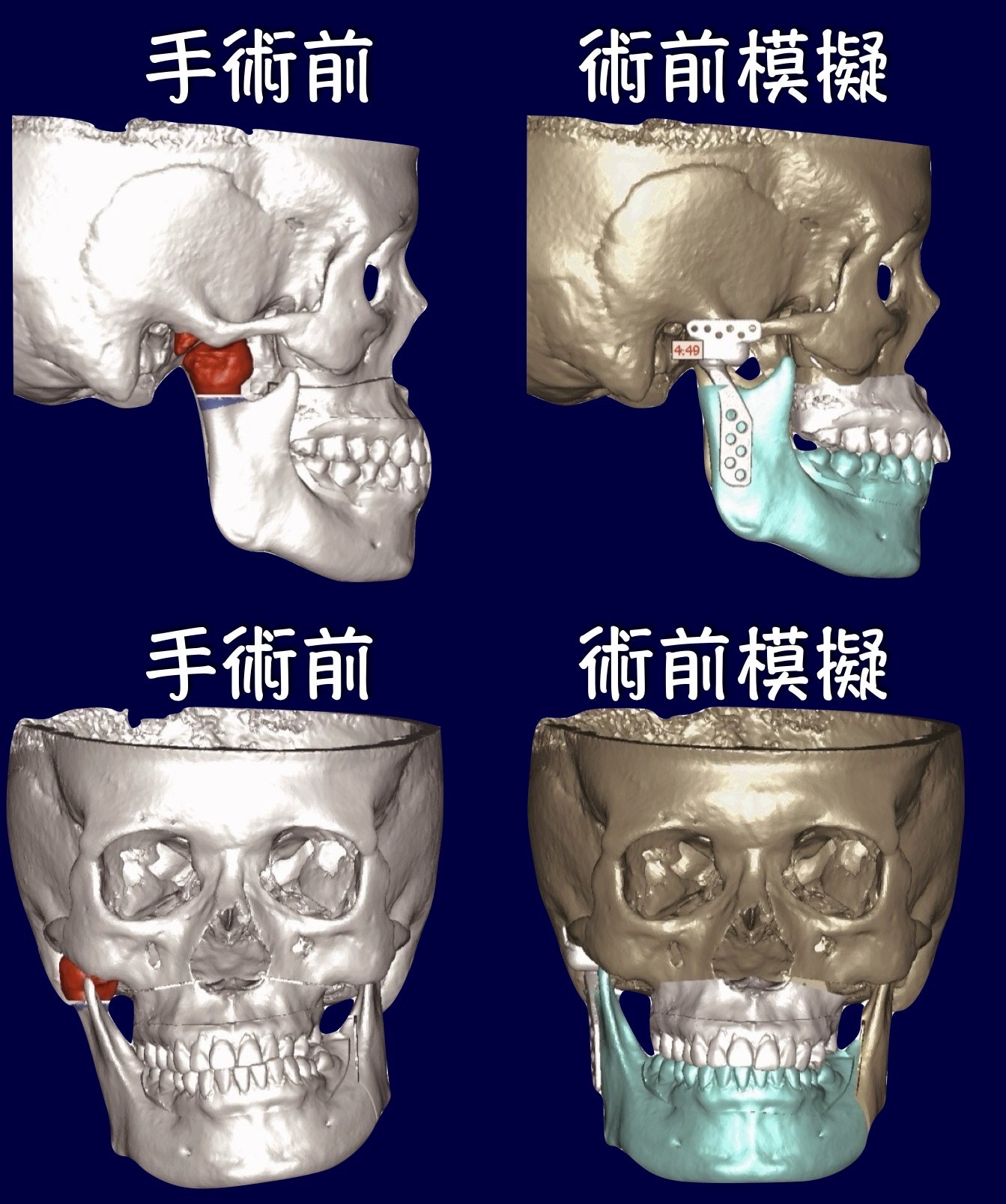 術前利用數位模擬替病患精準定位正顎手術計畫、腫瘤切除範圍(紅色區域)與人工顳顎關節固定位置(白色區域)。圖/林口長庚醫院提供
