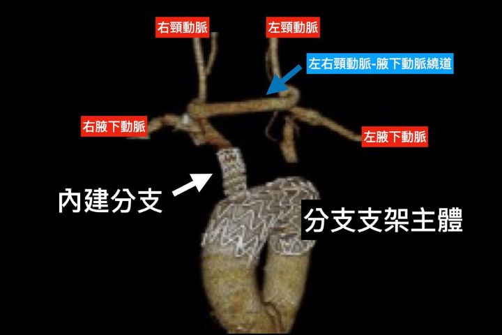 胸主動脈分支支架示意圖。圖/長庚醫院提供