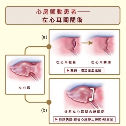 心房顫動患者接受心臟手術併行左心耳關閉術，可有效降低未來中風風險。(a)為傳統左心耳截斷術、(b)為左心耳夾手術。圖/林口長庚醫院提供