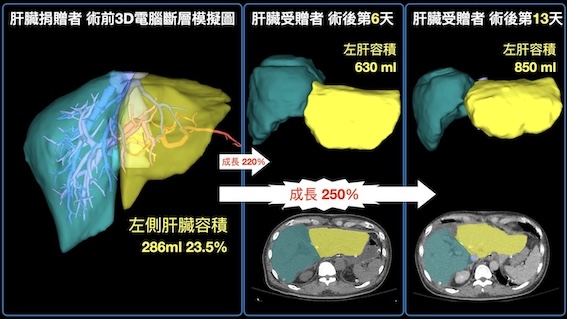 劉先生罹患肝病，高雄長庚醫院施以兩階段活體肝臟移植手術，成功完成移植，圖為肝臟的術前與術後情形。圖/高雄長庚提供