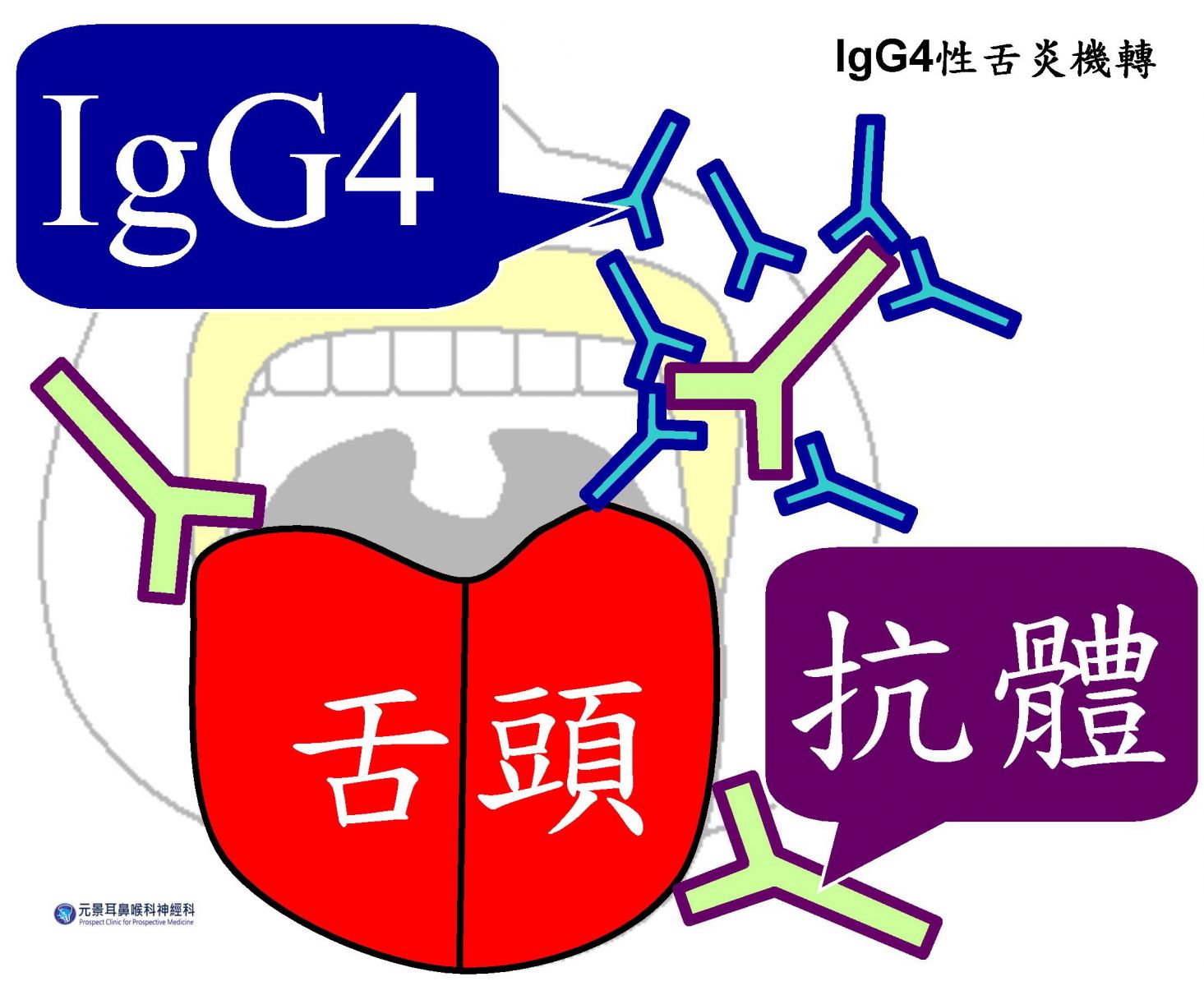 IgG4性舌炎機轉，抗體攻擊舌部，IgG4與抗體結合，抑制抗體。圖/陳建志醫師提供