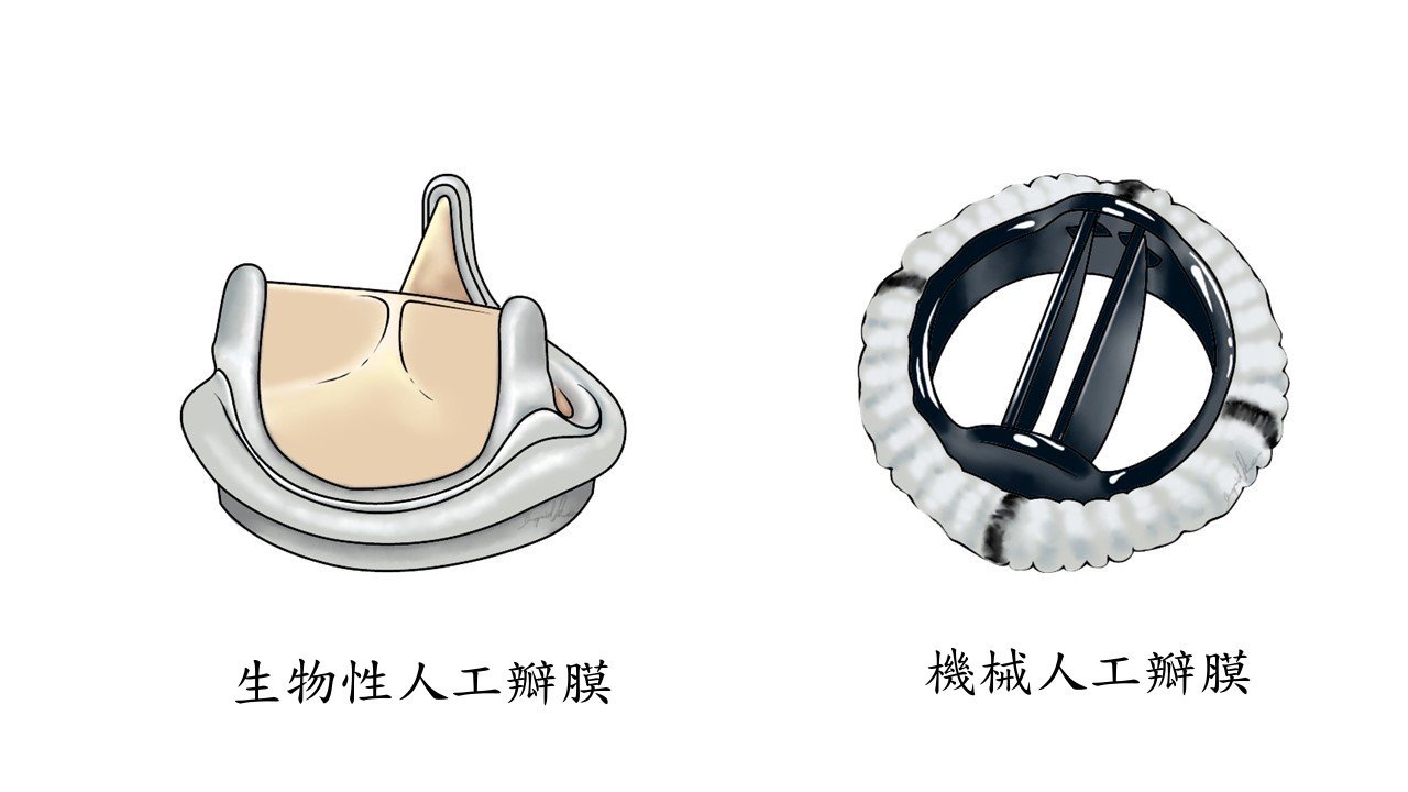 左為生物性人工瓣膜，右為機械人工瓣膜。圖/長庚醫院提供