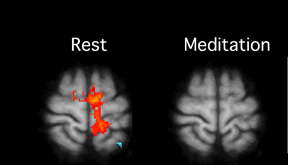 左圖所顯示的紅色區塊，是受測者在休息時，進行痛覺測試的大腦反應。右圖則是受測者在深度禪定時，大腦接受相同刺激，但並未顯示出疼痛反應。（資料來源：ScienceDaily，April 11，2011）。圖/禪天下雜誌提供