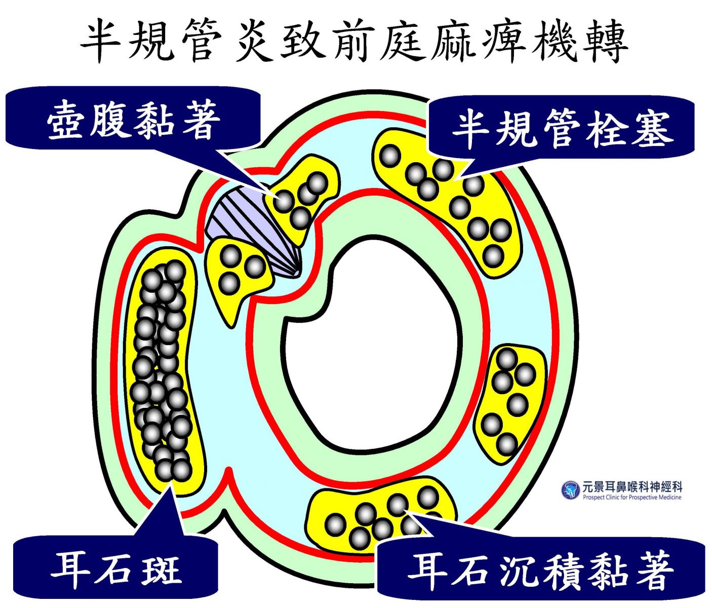 感染性半規管炎致前庭麻痺機轉，症狀很像前庭神經炎。圖/元景耳鼻喉科神經科