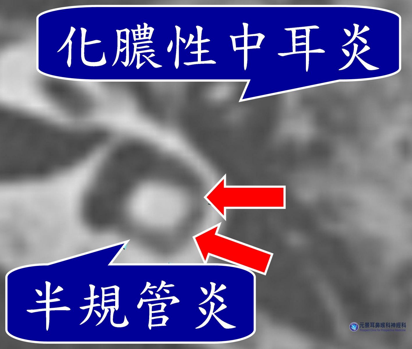 電腦斷層顯示左側化膿性中耳炎，併發感染性半規管炎，半規管內有白白的物質（箭頭所指）。圖/元景耳鼻喉科神經科