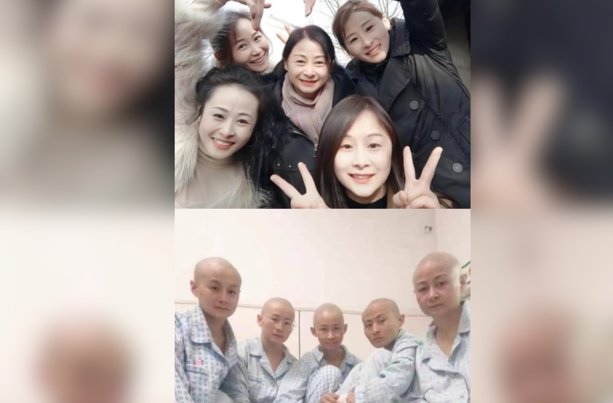 「最美五朵金花」（上圖）全剃光頭（下圖），捐皮給小姊弟植皮。圖/取自極目新聞