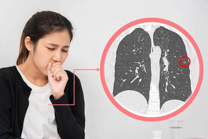 肺腺癌病患中，男女比例差異不大，但有超過9成女性患者不抽菸、男性僅4成。圖/取自西園醫院官網