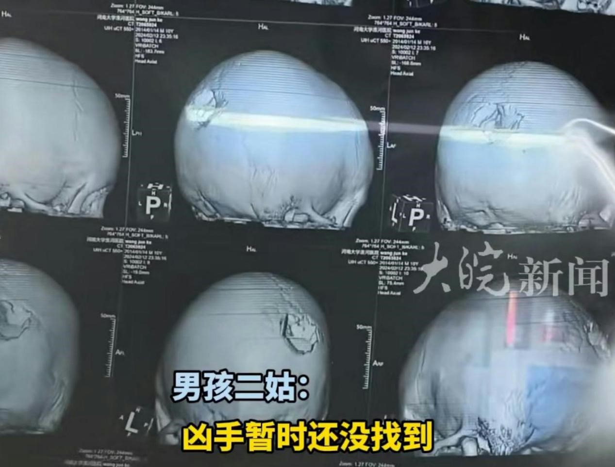 遭路邊施放的「狼嚎火箭」射穿腦門的孩童頭骨照。圖/翻攝自大皖新聞