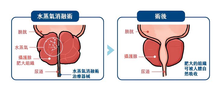 攝護腺水蒸氣微創消融手術的治療原理。圖/長庚醫院提供