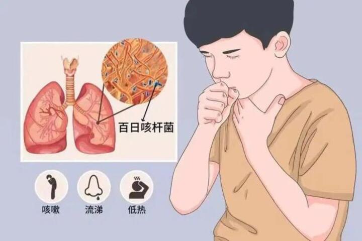 圖解百日咳。圖/取自《澎湃新聞》