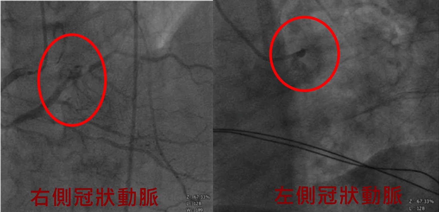 影像檢查顯示，患者雙側冠狀動脈嚴重阻塞。圖/童綜合醫院提供