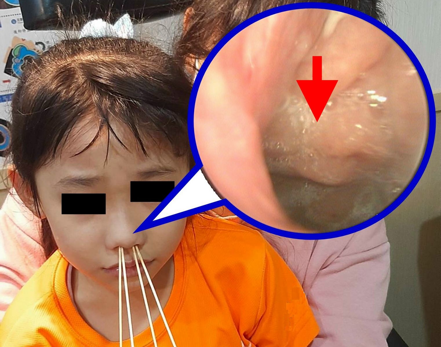 該童就診時，鼻咽內視鏡顯示鼻咽腺樣體腫大（箭頭所指）。圖/陳建志醫師提供