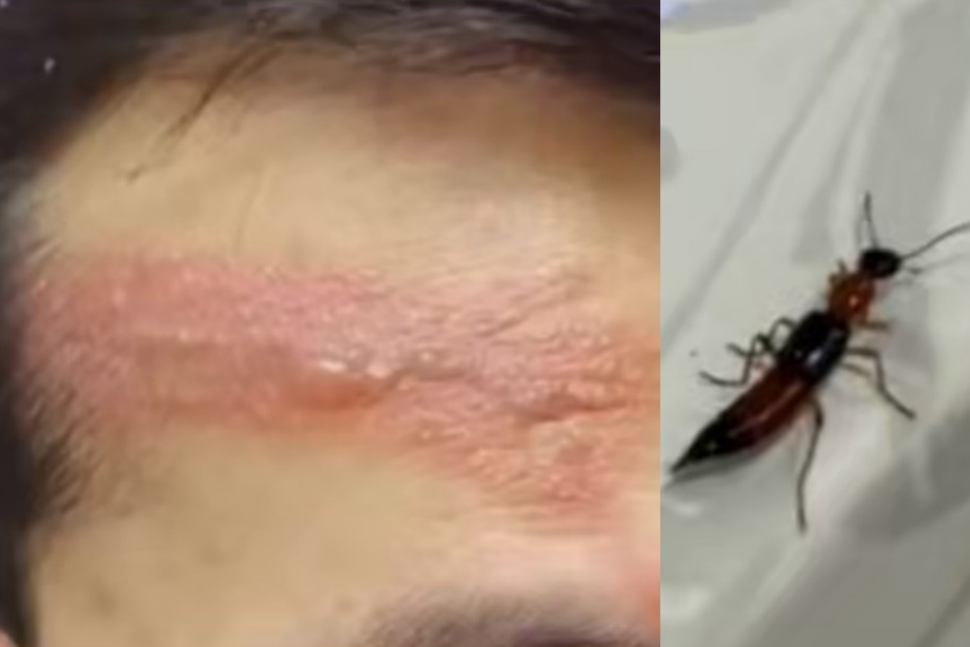 氣溫快速回升，被稱為「飛行硫酸」會引發皮灼傷（左）的隱翅蟲（右）將進入活躍期。圖/取自浙江交通之聲微博