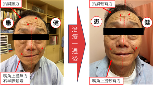 病人治療前後比較。圖/廖皓涵醫師提供