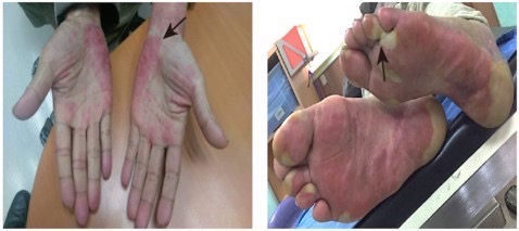 補充鋅能改善部分使用Regorafenib病人的手足皮膚症狀。圖/長庚提供