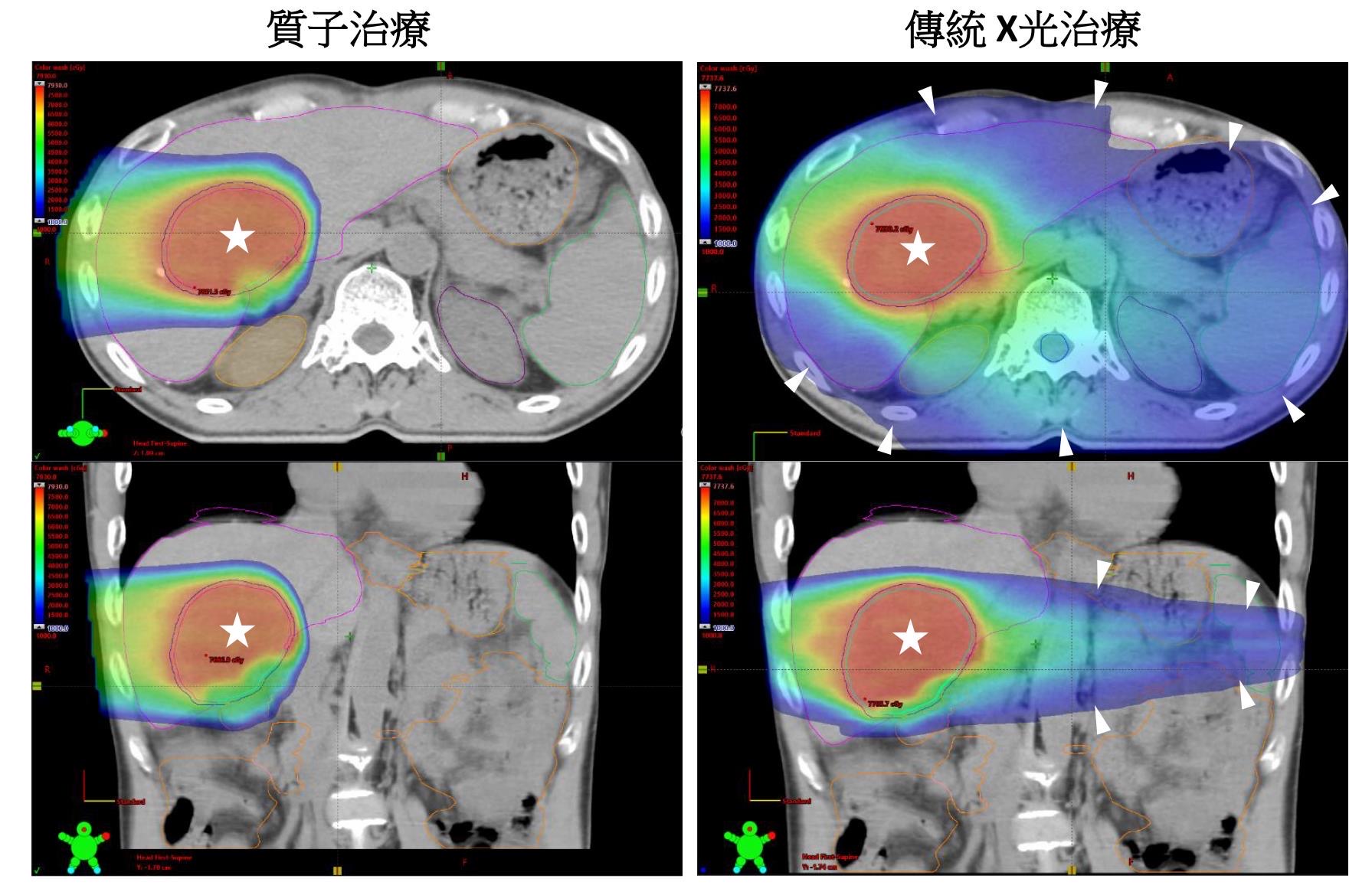 質子治療相較傳統X光放射治療可更集中狙擊腫瘤(星號)，並降低腫瘤周圍肝臟、腸胃道及脾臟等器官的輻射暴露(箭號彩色區域)，減少副作用。圖/長庚醫院提供