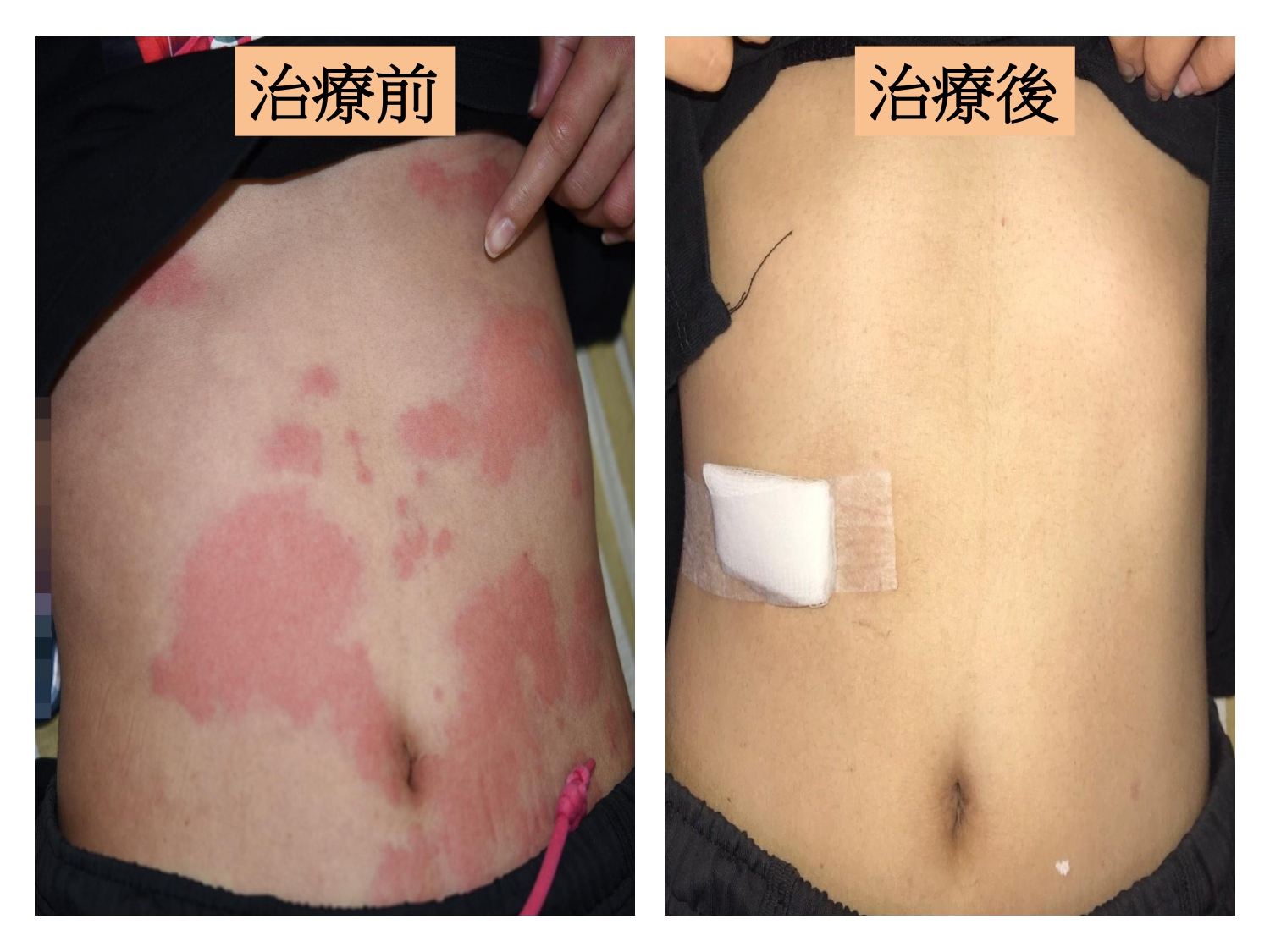 病患治療前（左）身體多處蕁麻疹樣皮疹，伴隨搔癢燒灼感。治療一週後（右），紅疹幾乎消失，只留下發炎後色素沉澱。圖/台中仁愛醫院提供