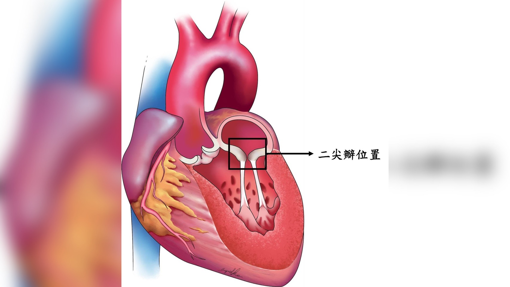 二尖瓣嚴重病患需要手術治療，手術方式包括二尖瓣修補或置換手術。圖為二尖瓣位置。圖/長庚醫院提供